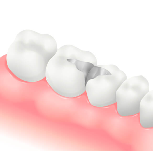 伊勢原の歯科・歯医者 越光歯科医院のメタルインレー（詰め物）