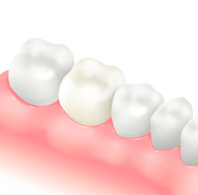 伊勢原の歯科・歯医者 越光歯科医院のセラミッククラウン（前歯、奥歯被せ物）