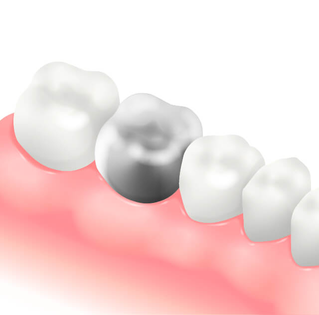 伊勢原の歯科・歯医者 越光歯科医院のメタルクラウン（奥歯被せ物）