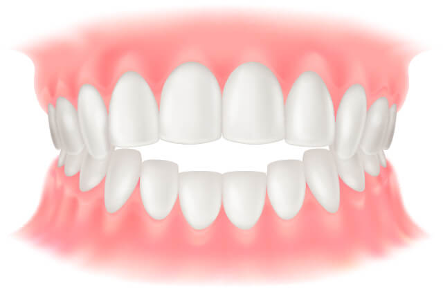 伊勢原の歯科・歯医者 越光歯科医院の開咬について