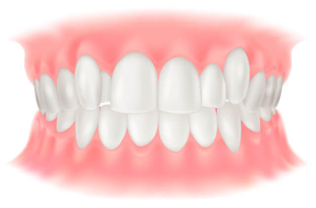 伊勢原の歯科・歯医者 越光歯科医院の八重歯、叢生について