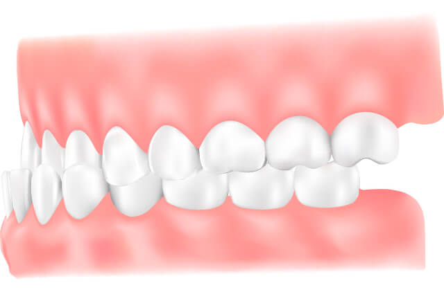 伊勢原の歯科・歯医者 越光歯科医院の下顎前突について