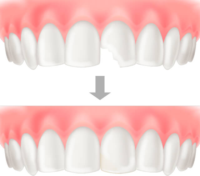 伊勢原の歯科・歯医者 越光歯科医院のダイレクトセラミック（詰め物）