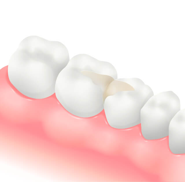 伊勢原の歯科・歯医者 越光歯科医院のコンポジットレジン（詰め物）