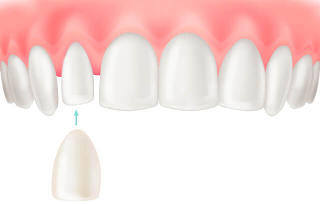 伊勢原の歯医者 越光歯科医院のラミネートベニア