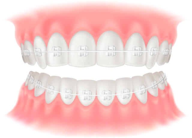 伊勢原の歯科・歯医者 越光歯科医院のワイヤー装置について
