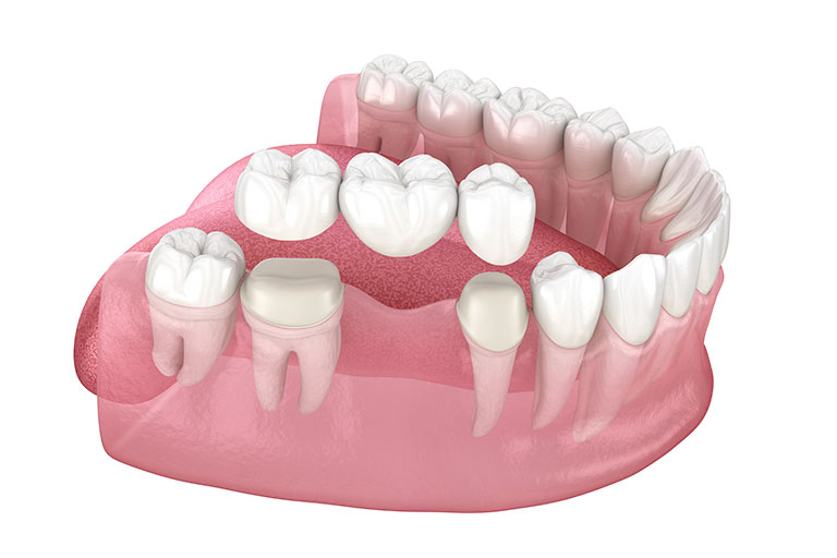 ブリッジについて