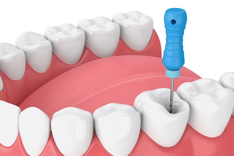伊勢原の歯科・歯医者 越光歯科医院の根管治療（こんかんちりょう）とは